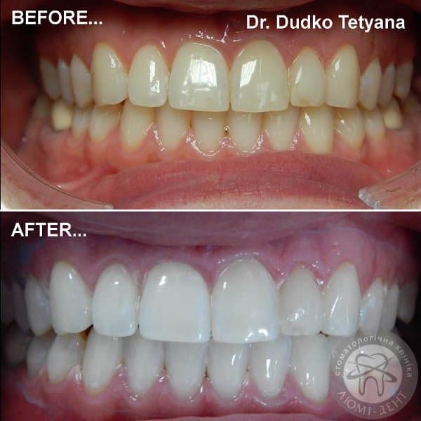 Результати освітлення у пацієнтів нашої стоматології:
